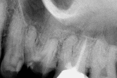 5-canalled upper molar