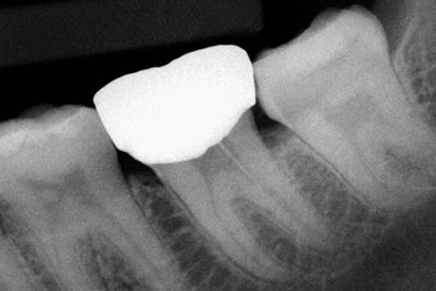 Lower molar Re-treatment with perforation 