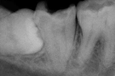 Lower second molar 3-2-1 