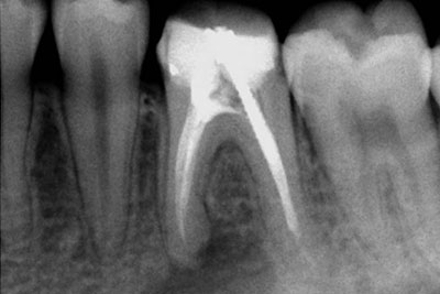 Mandibular molar Re-treatment 