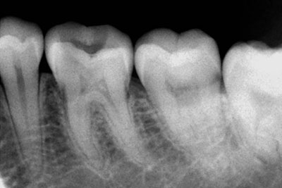 Molar with Perforation 