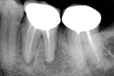 Re-treatment of mandibular molar with lesion 