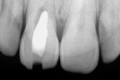 Calcified incisor 