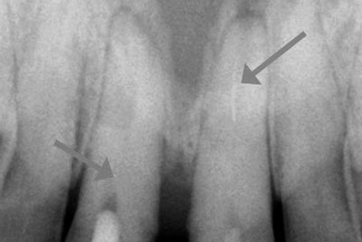 Calcified canal and broken instrument 