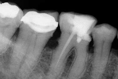 Calcified lower molar 